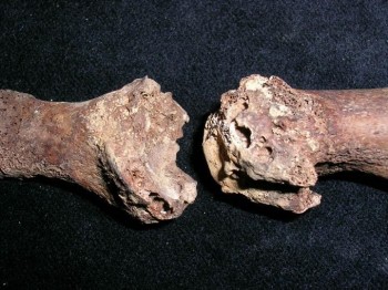 Figure 8: Destructive lesion on the distal aspect of metatarsal 1, lateral view of gout. Chelsea Old Church. Museum of London 2019, extracted 18.10.19.