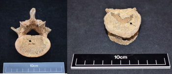 Figure 3: Schmorl's nodes on vertebral bodies (above). Small central Schmorl's node on inferior vertebral body of L2 (Left). Large Schmorl’s nodes located on the superior body of T8 (right). (Authors own.).