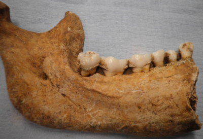 Figure 1: Calculus adhering to the teeth of an Iron Age individual (Image Copyright: Authors)