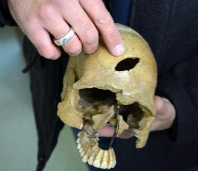 Figure 3: A reconstructed skull recovered from Ofnet Cave, showing distinctively shaped bludgeon wound.  (Image:  Ludwig-Maximilians-Universität, München)